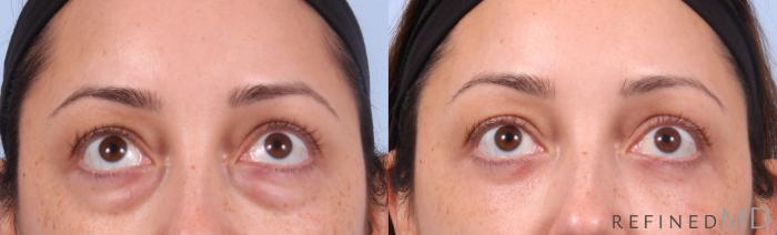 Before & After Lower Eyelid Case 1144 Up Gaze View in Los Gatos & San Jose, CA