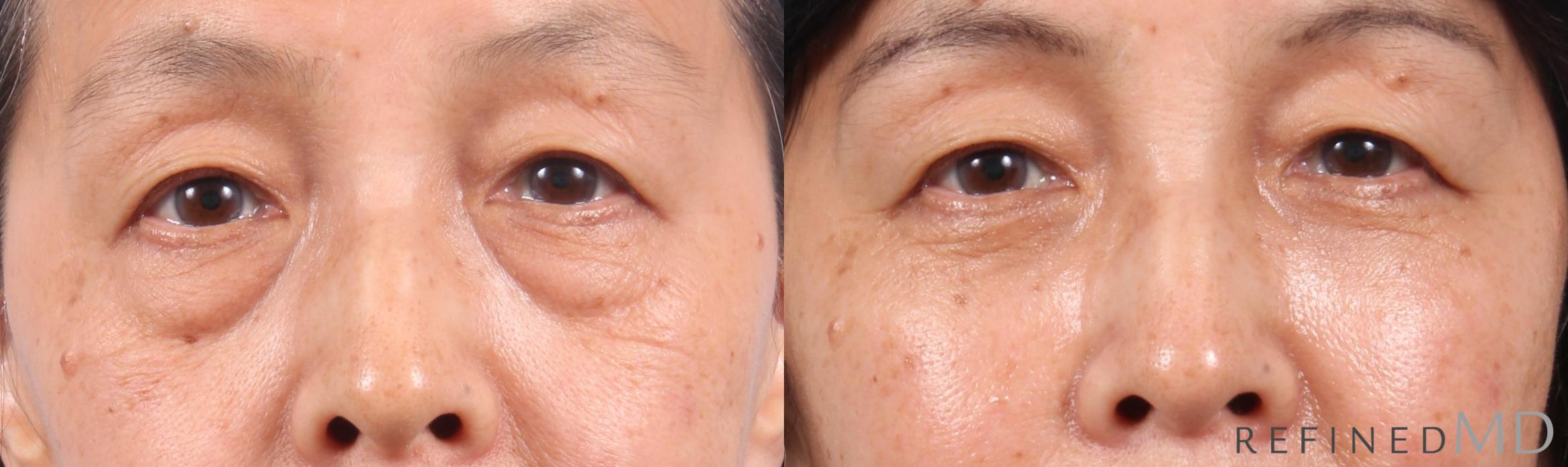 Before & After Lower Eyelid Case 1145 Front View in Los Gatos & San Jose, CA