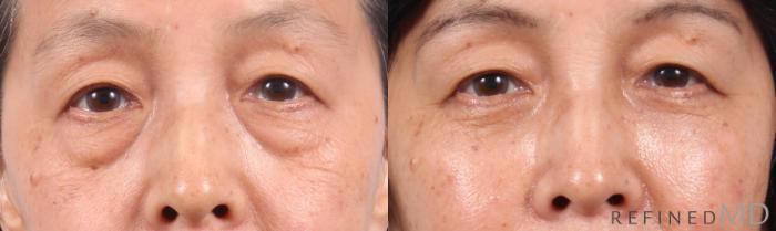 Before & After Lower Eyelid Case 1145 Front View in Los Gatos & San Jose, CA