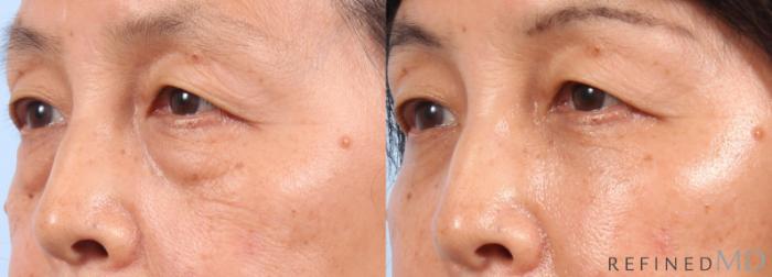 Before & After Lower Eyelid Case 1145 Left Oblique View in Los Gatos & San Jose, CA