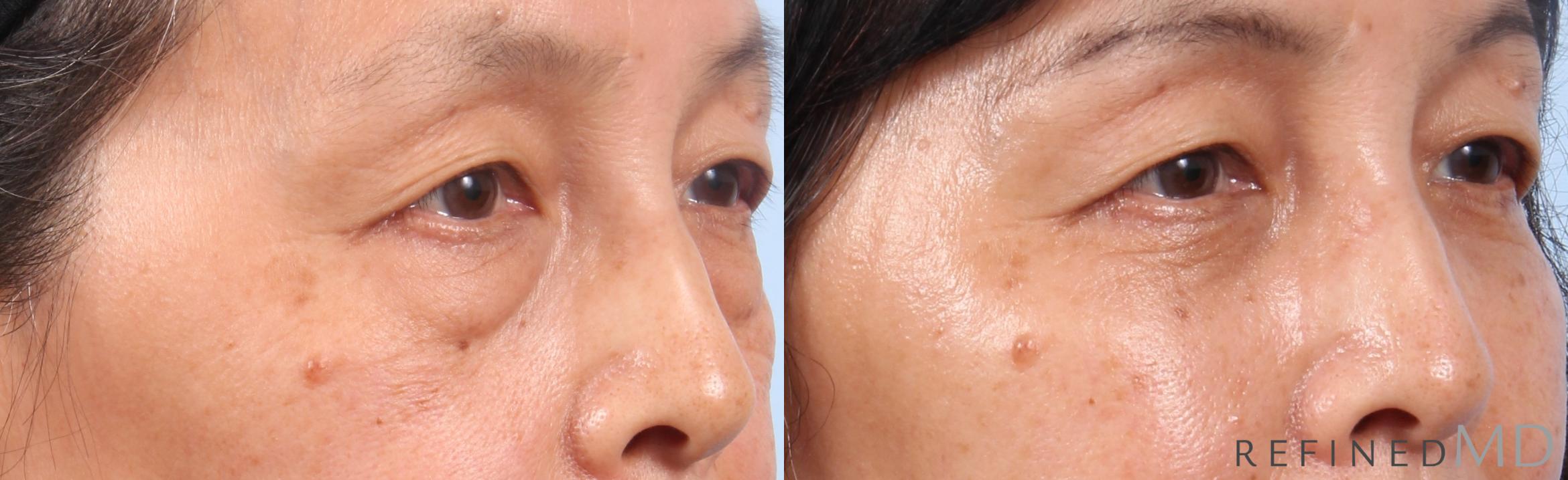 Before & After Lower Eyelid Case 1145 Right Oblique View in Los Gatos & San Jose, CA