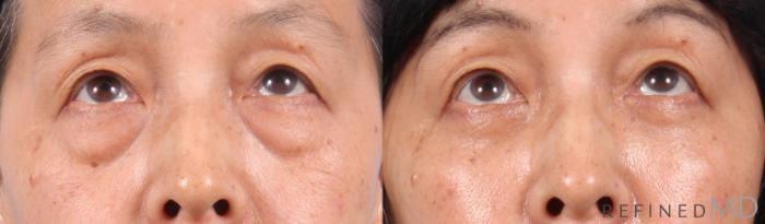 Before & After Lower Eyelid Case 1145 Up Gaze View in Los Gatos & San Jose, CA