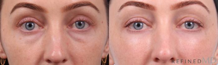 Before & After Lower Eyelid Case 1147 Front View in Los Gatos & San Jose, CA