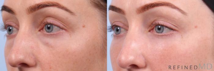 Before & After Lower Eyelid Case 1147 Left Oblique View in Los Gatos & San Jose, CA