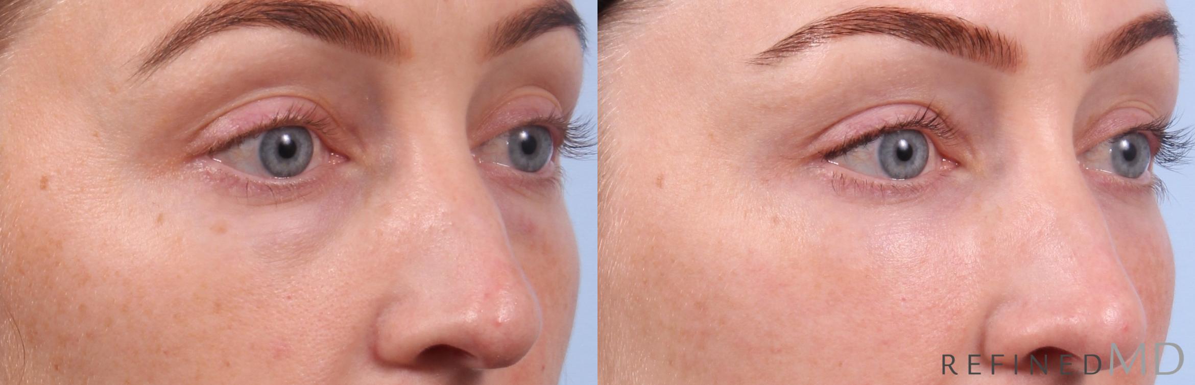 Before & After Lower Eyelid Case 1147 Right Oblique View in Los Gatos & San Jose, CA