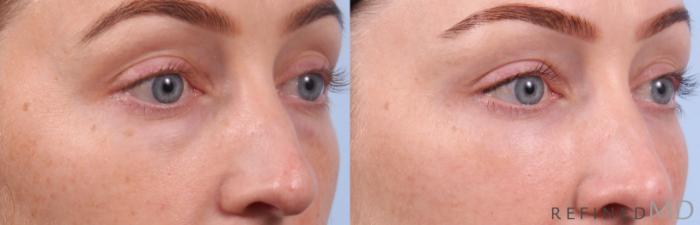 Before & After Lower Eyelid Case 1147 Right Oblique View in Los Gatos & San Jose, CA