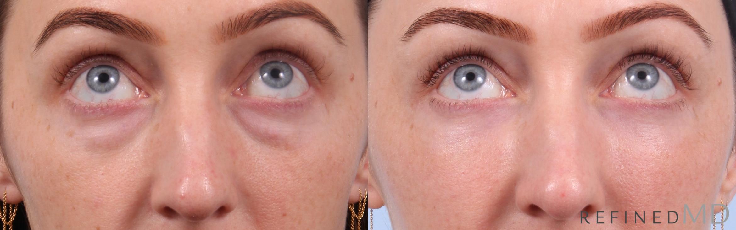Before & After Lower Eyelid Case 1147 Up Gaze View in Los Gatos & San Jose, CA