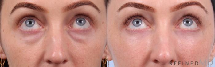 Before & After Lower Eyelid Case 1147 Up Gaze View in Los Gatos & San Jose, CA