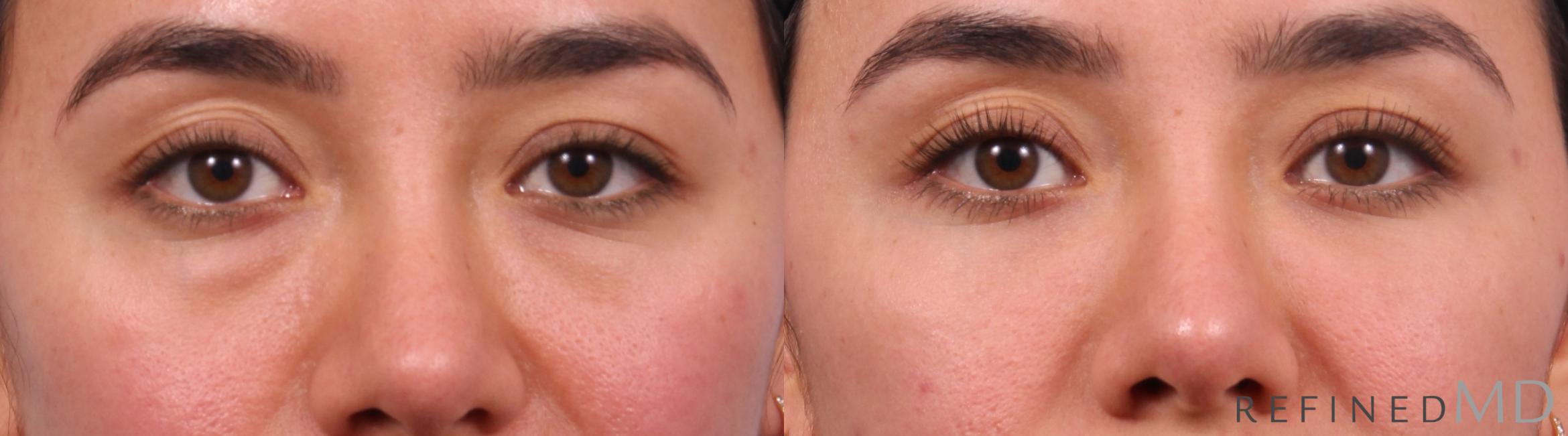 Before & After Lower Eyelid Case 1148 Front View in Los Gatos & San Jose, CA