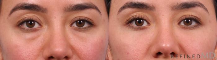 Before & After Lower Eyelid Case 1148 Front View in Los Gatos & San Jose, CA