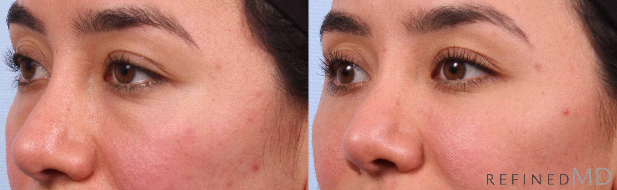 Before & After Lower Eyelid Case 1148 Left Oblique View in Los Gatos & San Jose, CA