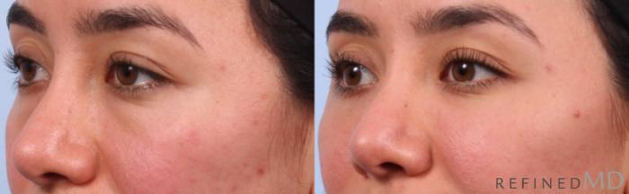 Before & After Lower Eyelid Case 1148 Left Oblique View in Los Gatos & San Jose, CA