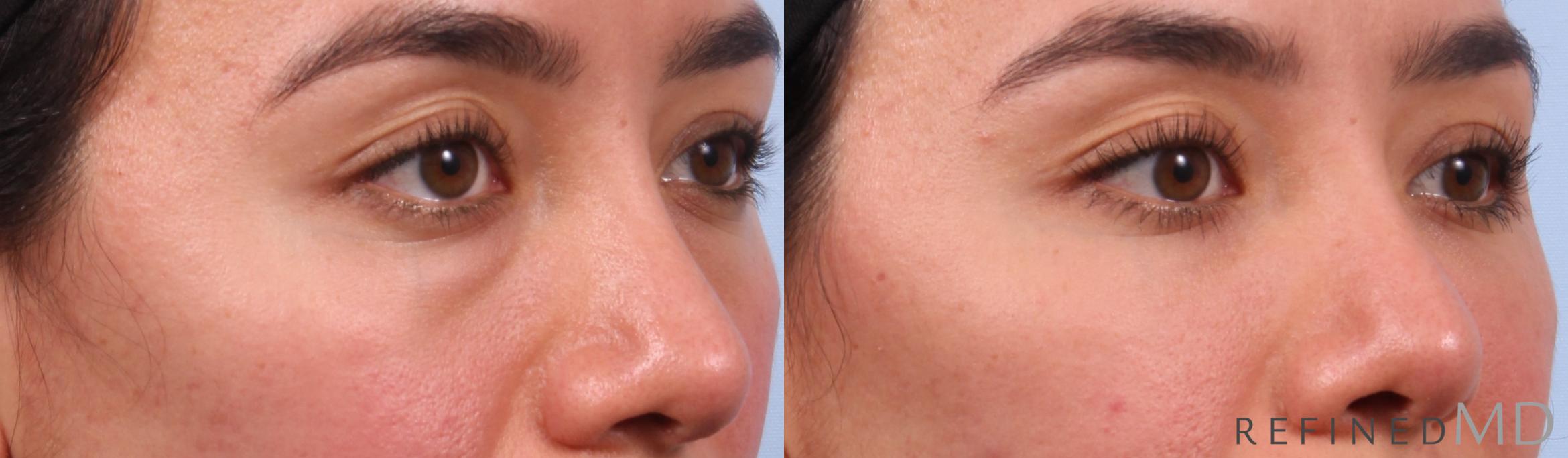 Before & After Lower Eyelid Case 1148 Right Oblique View in Los Gatos & San Jose, CA