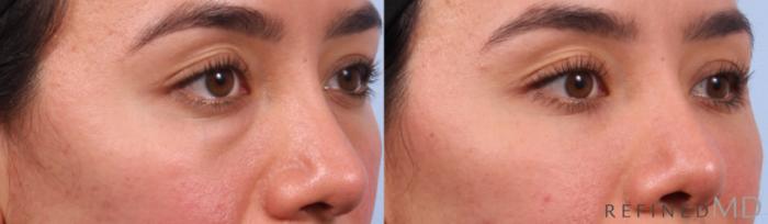 Before & After Lower Eyelid Case 1148 Right Oblique View in Los Gatos & San Jose, CA