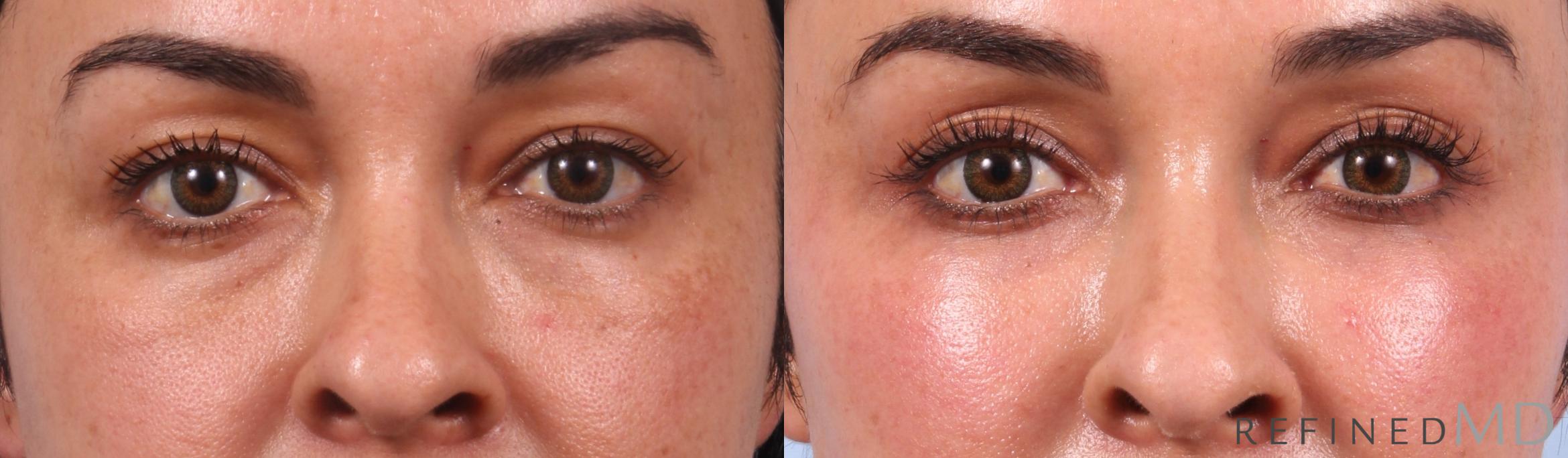 Before & After Lower Eyelid Case 1149 Front View in Los Gatos & San Jose, CA