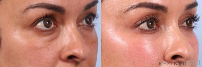 Before & After Lower Eyelid Case 1149 Left Oblique View in Los Gatos & San Jose, CA