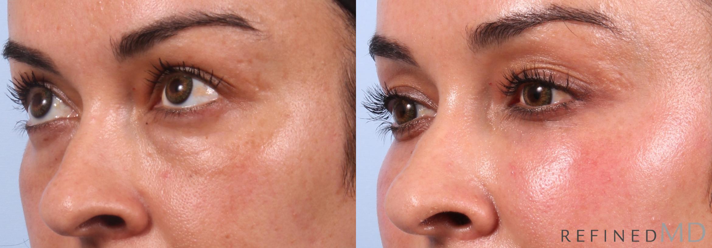 Before & After Lower Eyelid Case 1149 Left Side View in Los Gatos & San Jose, CA