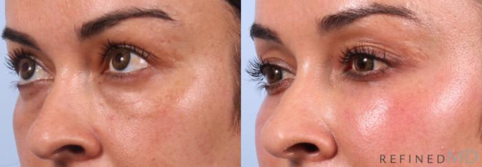 Before & After Lower Eyelid Case 1149 Left Side View in Los Gatos & San Jose, CA