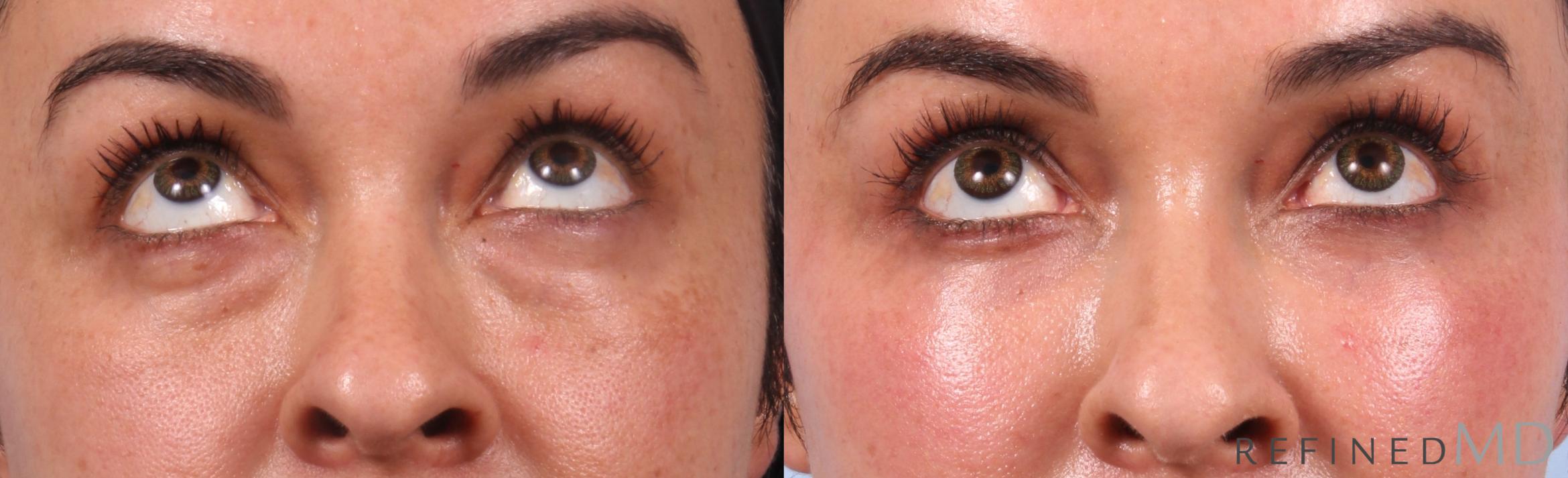 Before & After Lower Eyelid Case 1149 Up Gaze View in Los Gatos & San Jose, CA