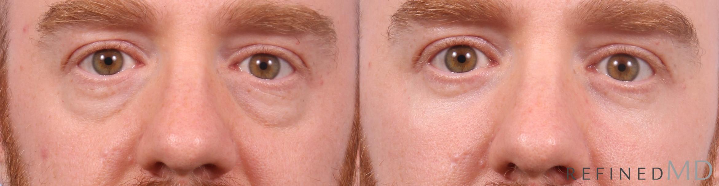 Before & After Lower Eyelid Case 1151 Front View in Los Gatos & San Jose, CA