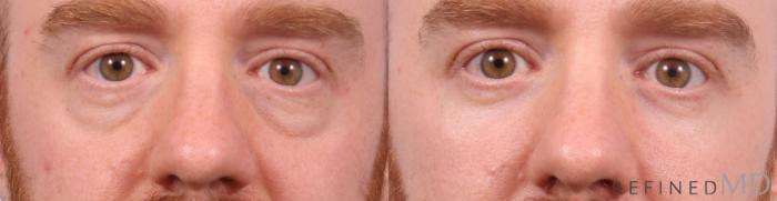 Before & After Lower Eyelid Case 1151 Front View in Los Gatos & San Jose, CA