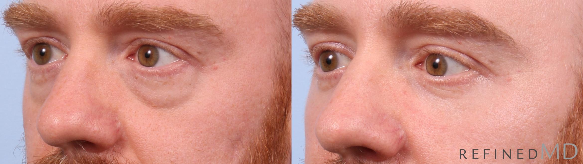 Before & After Lower Eyelid Case 1151 Left Oblique View in Los Gatos & San Jose, CA