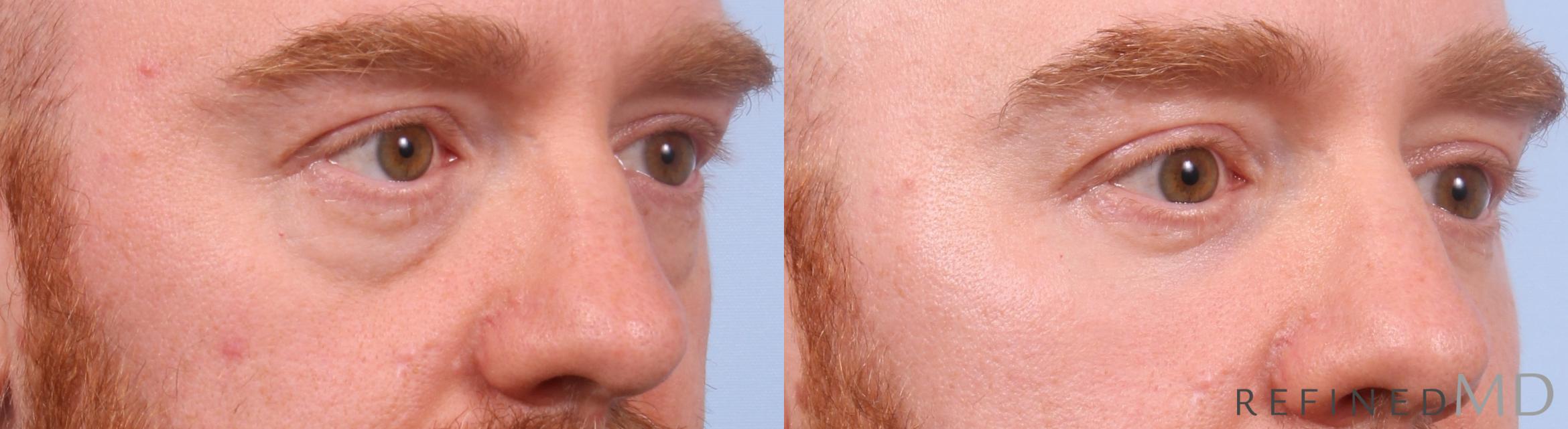 Before & After Lower Eyelid Case 1151 Right Oblique View in Los Gatos & San Jose, CA