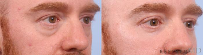 Before & After Lower Eyelid Case 1151 Right Oblique View in Los Gatos & San Jose, CA