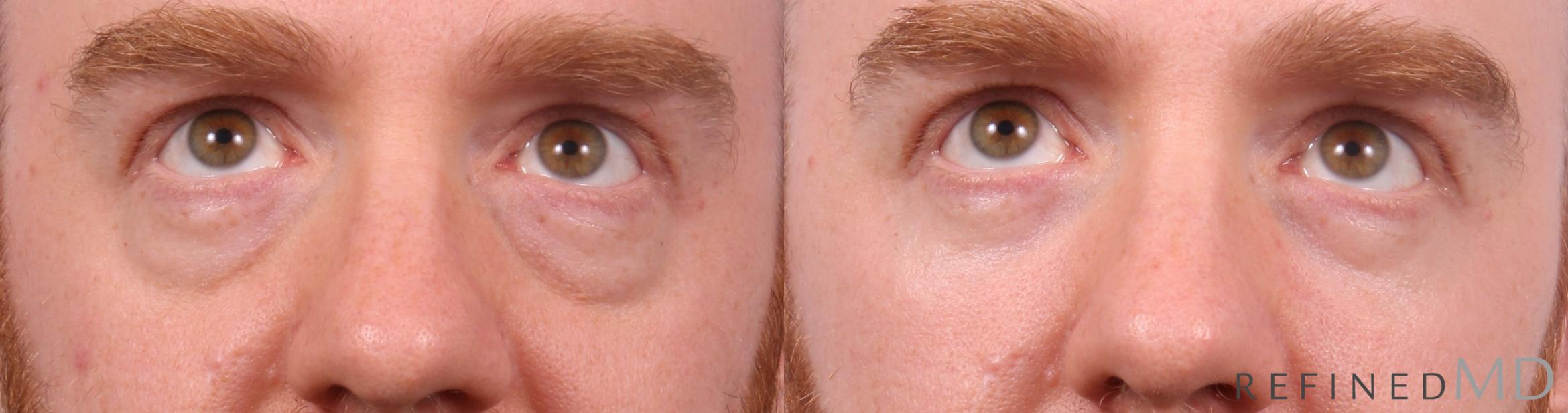 Before & After Lower Eyelid Case 1151 Up Gaze View in Los Gatos & San Jose, CA