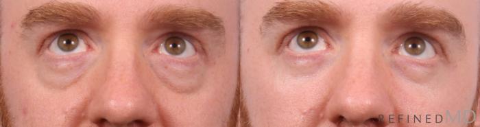 Before & After Lower Eyelid Case 1151 Up Gaze View in Los Gatos & San Jose, CA