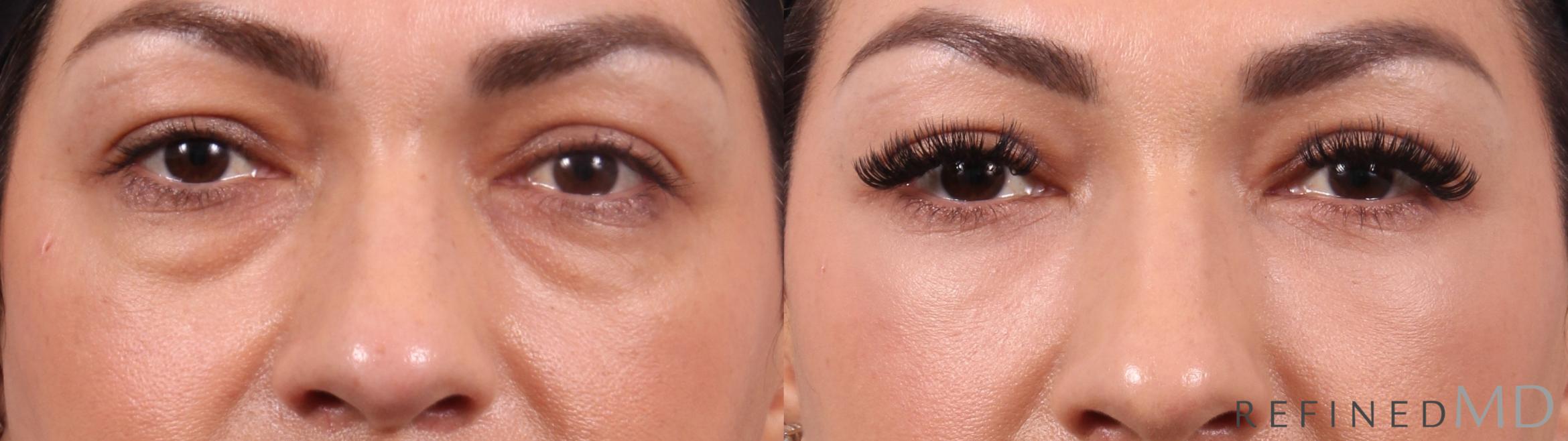 Before & After Lower Eyelid Case 1152 Front View in Los Gatos & San Jose, CA