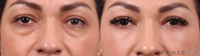 Before & After Lower Eyelid Case 1152 Front View in Los Gatos & San Jose, CA