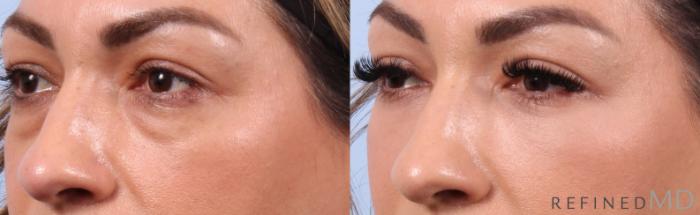 Before & After Lower Eyelid Case 1152 Left Oblique View in Los Gatos & San Jose, CA