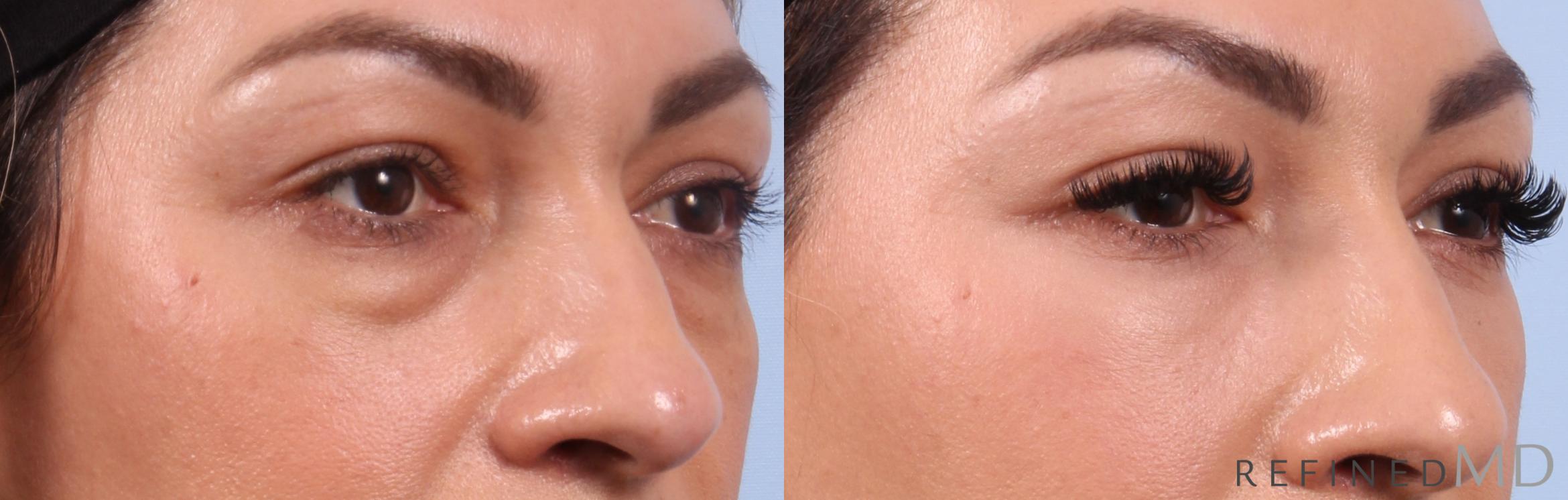 Before & After Lower Eyelid Case 1152 Right Oblique View in Los Gatos & San Jose, CA
