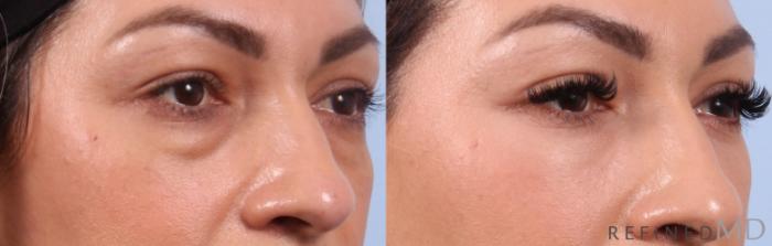 Before & After Lower Eyelid Case 1152 Right Oblique View in Los Gatos & San Jose, CA