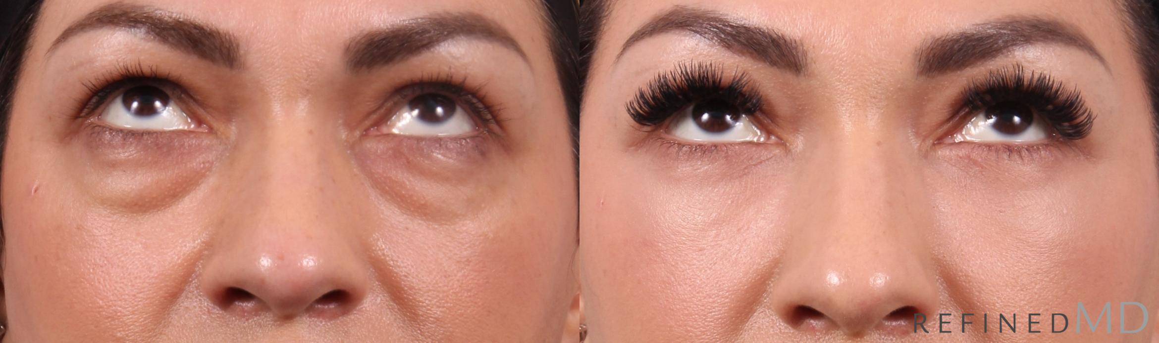 Before & After Lower Eyelid Case 1152 Up Gaze View in Los Gatos & San Jose, CA