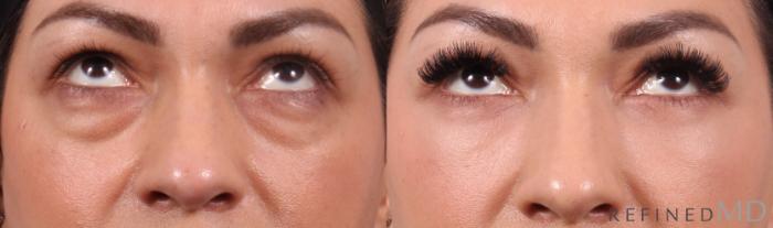 Before & After Lower Eyelid Case 1152 Up Gaze View in Los Gatos & San Jose, CA