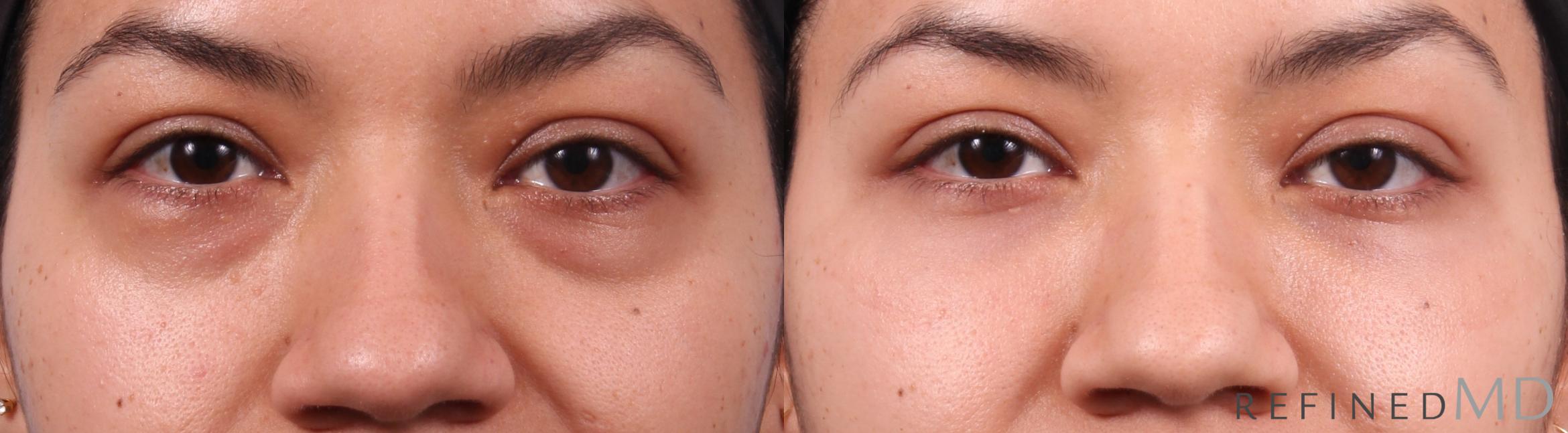 Before & After Lower Eyelid Case 1153 Front View in Los Gatos & San Jose, CA