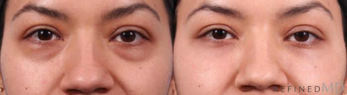 Before & After Lower Eyelid Case 1153 Front View in Los Gatos & San Jose, CA