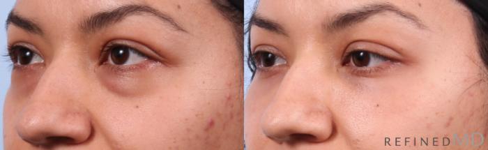 Before & After Lower Eyelid Case 1153 Left Oblique View in Los Gatos & San Jose, CA