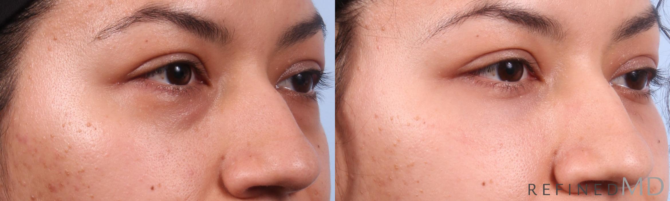 Before & After Lower Eyelid Case 1153 Right Oblique View in Los Gatos & San Jose, CA
