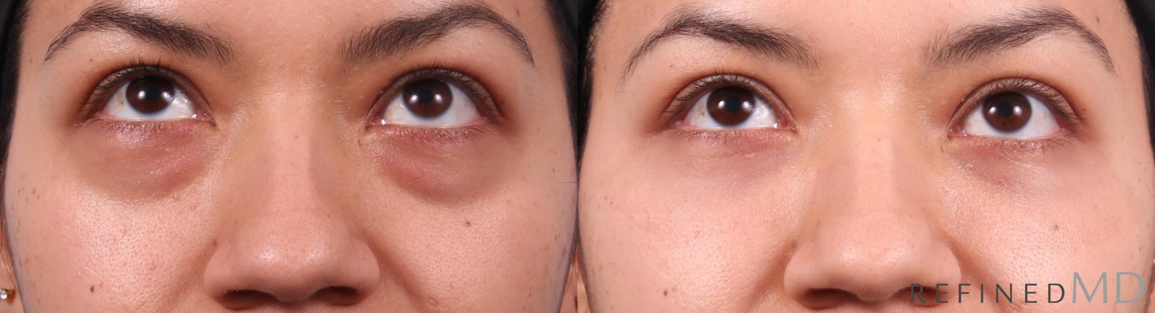 Before & After Lower Eyelid Case 1153 Up Gaze View in Los Gatos & San Jose, CA