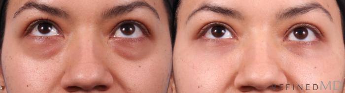 Before & After Lower Eyelid Case 1153 Up Gaze View in Los Gatos & San Jose, CA