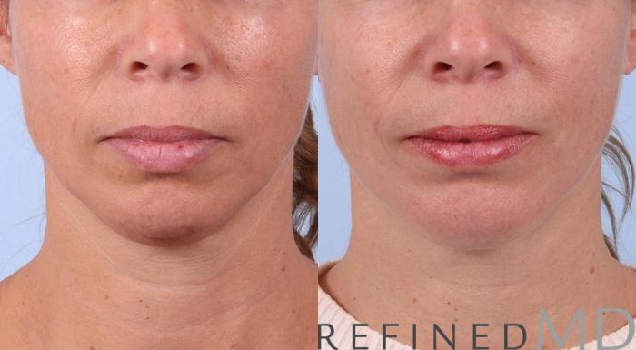 Before & After Necklift Case 1083 View 1 View in Los Gatos & San Jose, CA