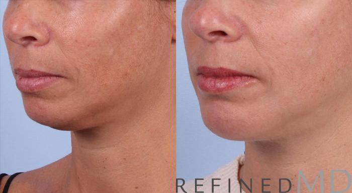 Before & After Necklift Case 1083 View 2 View in Los Gatos & San Jose, CA