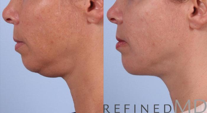 Before & After Necklift Case 1083 View 3 View in Los Gatos & San Jose, CA