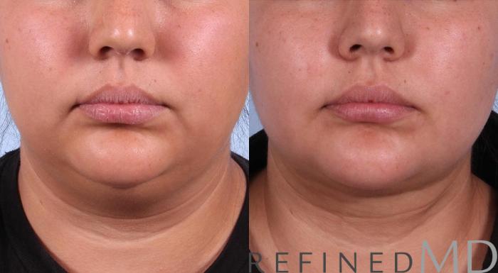 Before & After Necklift Case 1084 View 1 View in Los Gatos & San Jose, CA