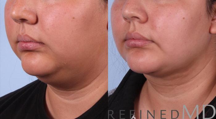 Before & After Necklift Case 1084 View 2 View in Los Gatos & San Jose, CA