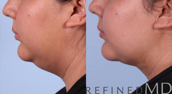 Before & After Necklift Case 1084 View 3 View in Los Gatos & San Jose, CA