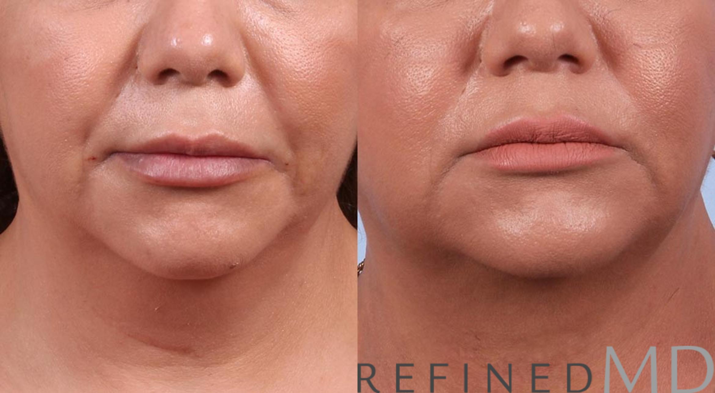 Before & After Necklift Case 1085 View 1 View in Los Gatos & San Jose, CA